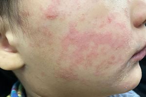 measles